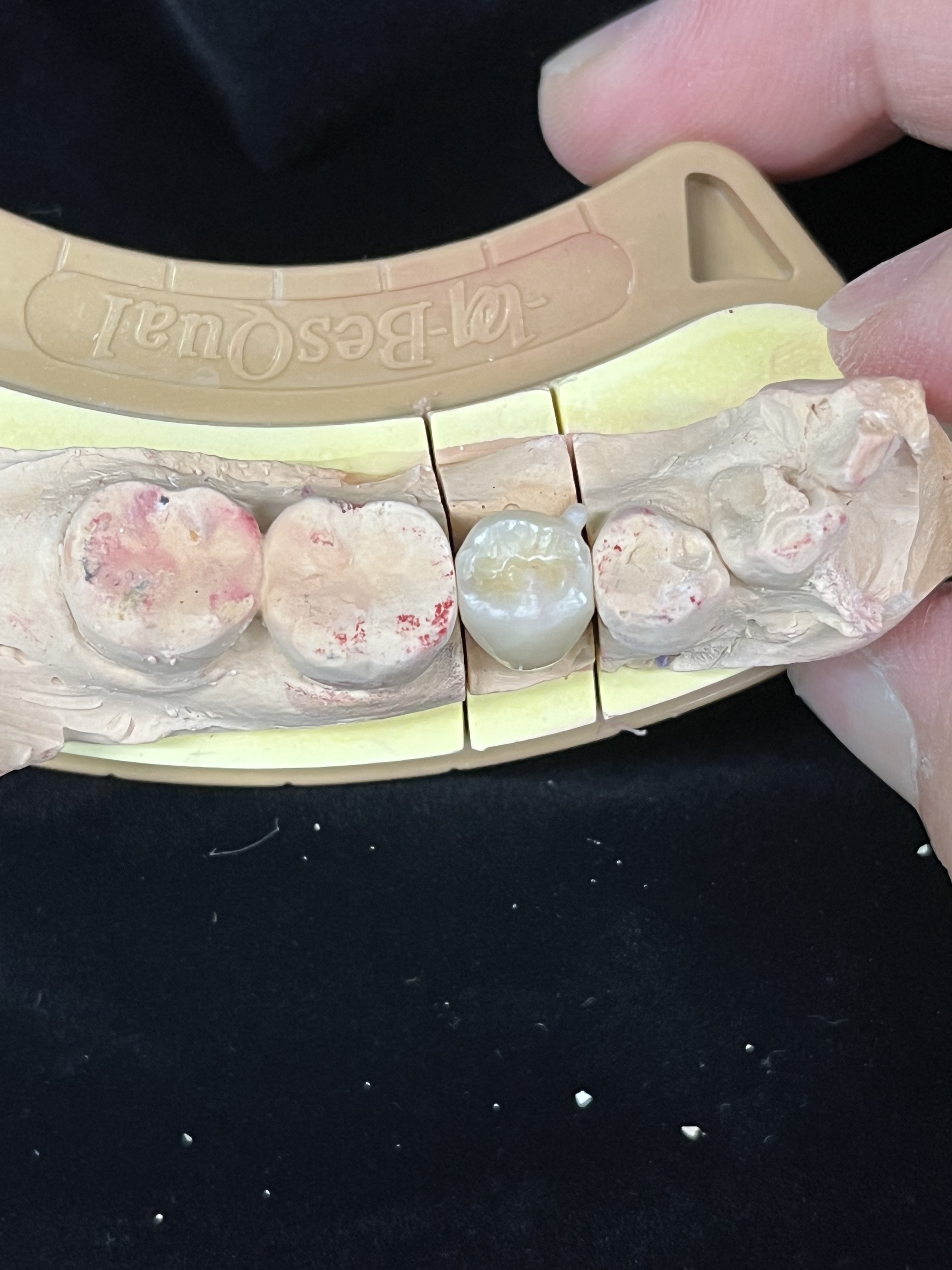 지르코니아 크라운 클로즈업